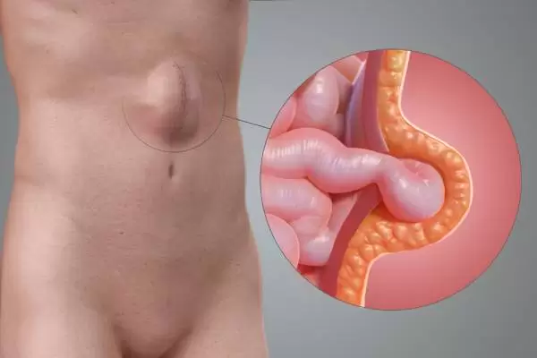 Gallbladder Stones