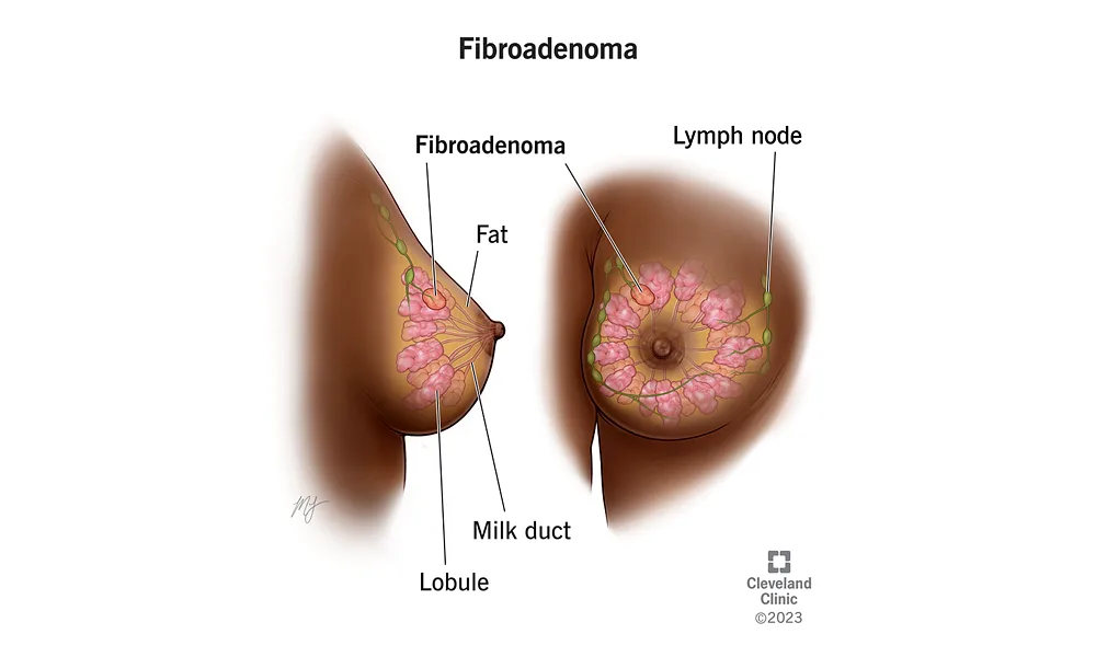 Gallbladder Stones