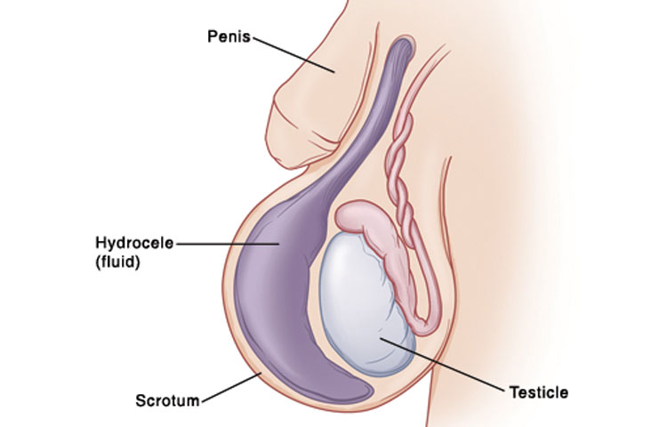 Gallbladder Stones