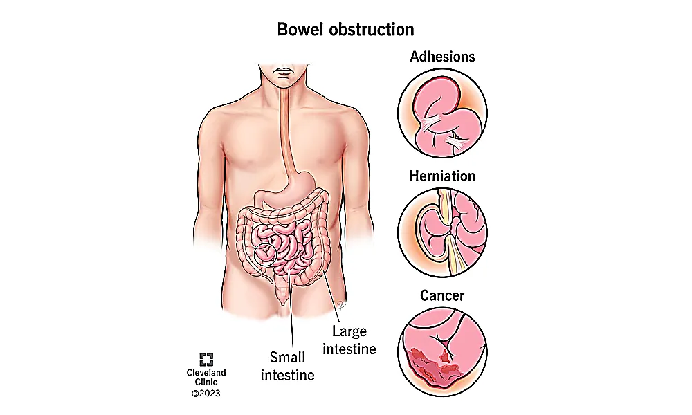 Gallbladder Stones